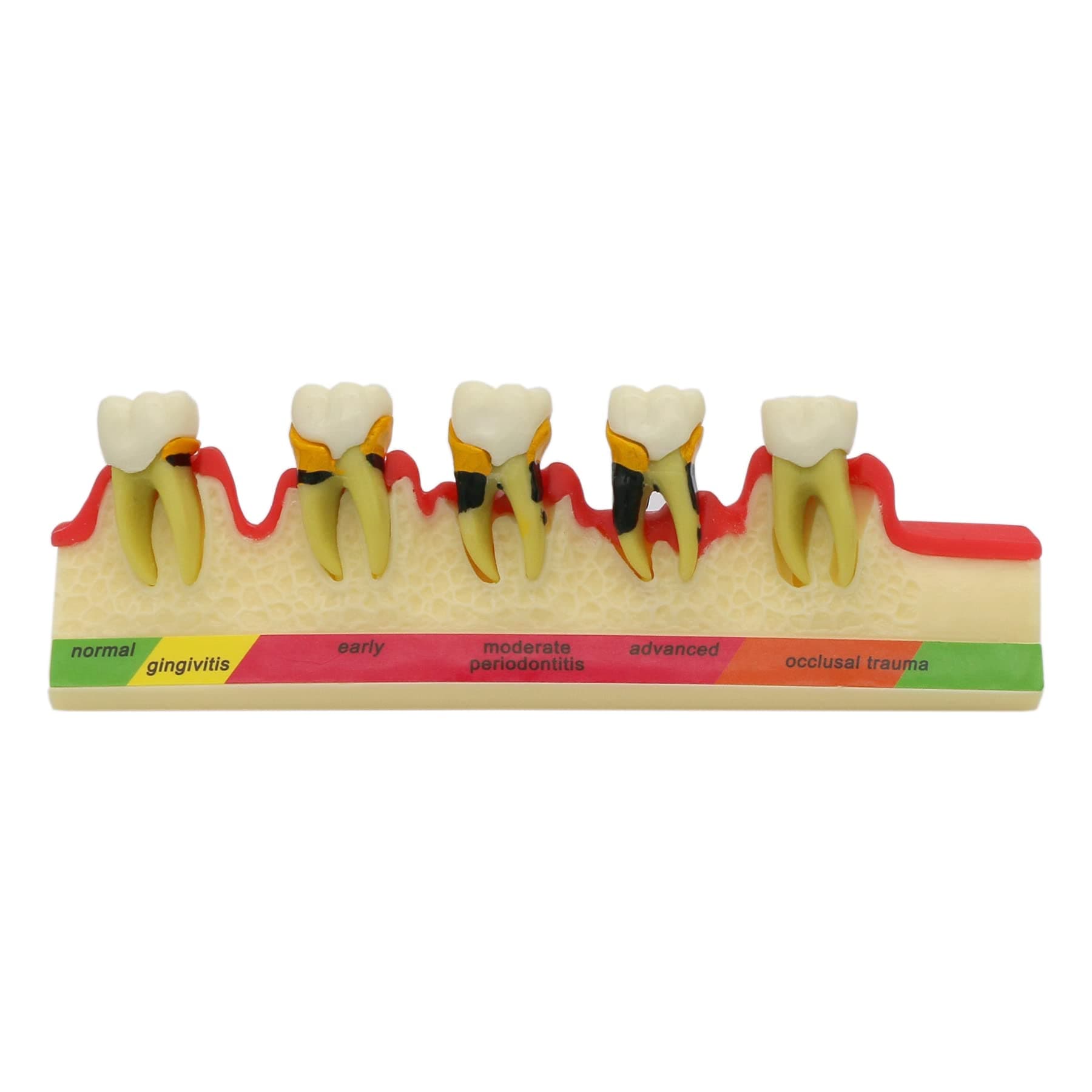 Lab Periodontal Disease Assort Tooth Typodont Teeth Model Study Teach 5-Stage Perio Disease Assort Demo (4010)