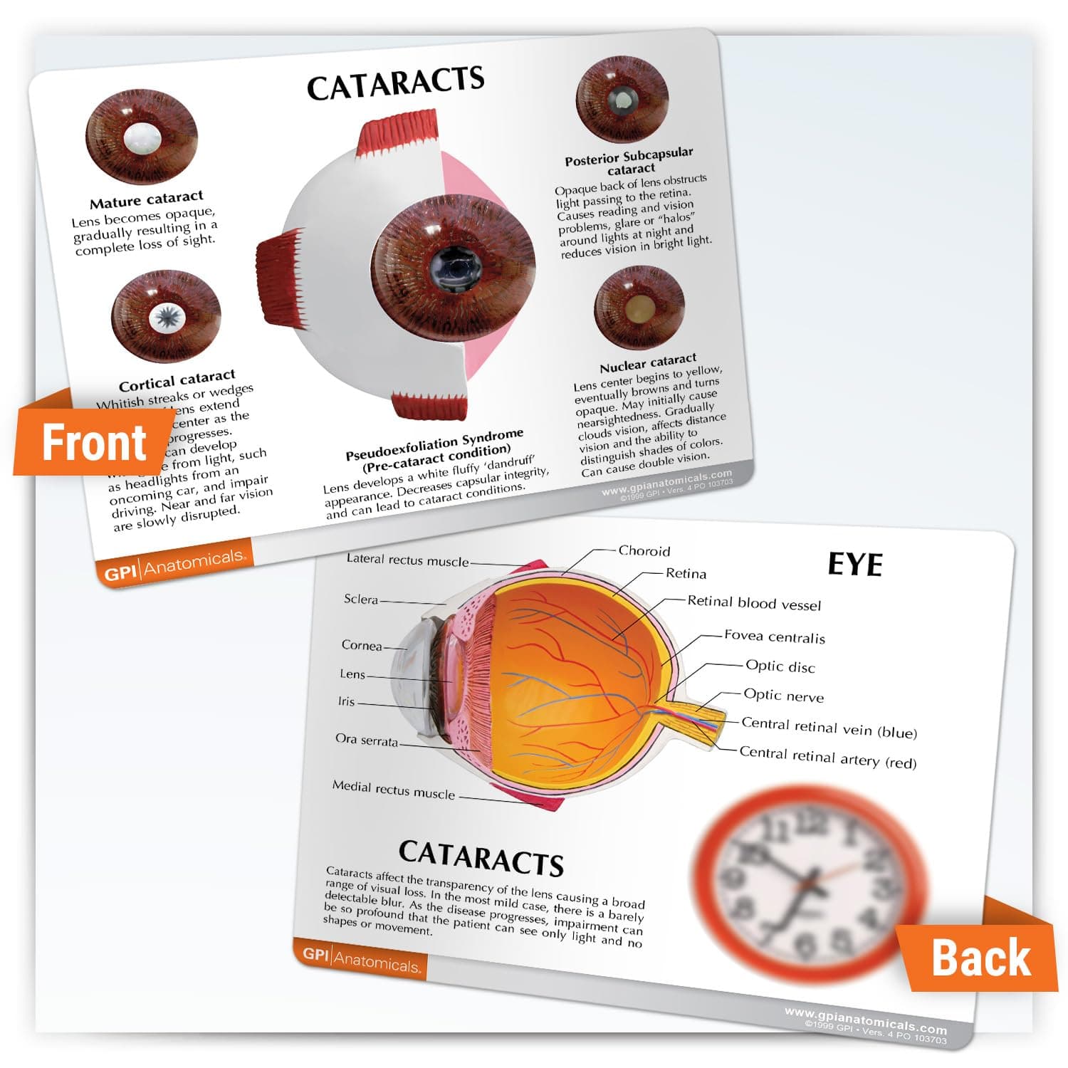 GPI Anatomicals 白内障アイモデル | 人体解剖学 眼と白内障の状態 医師 オフィス 教育ツール |