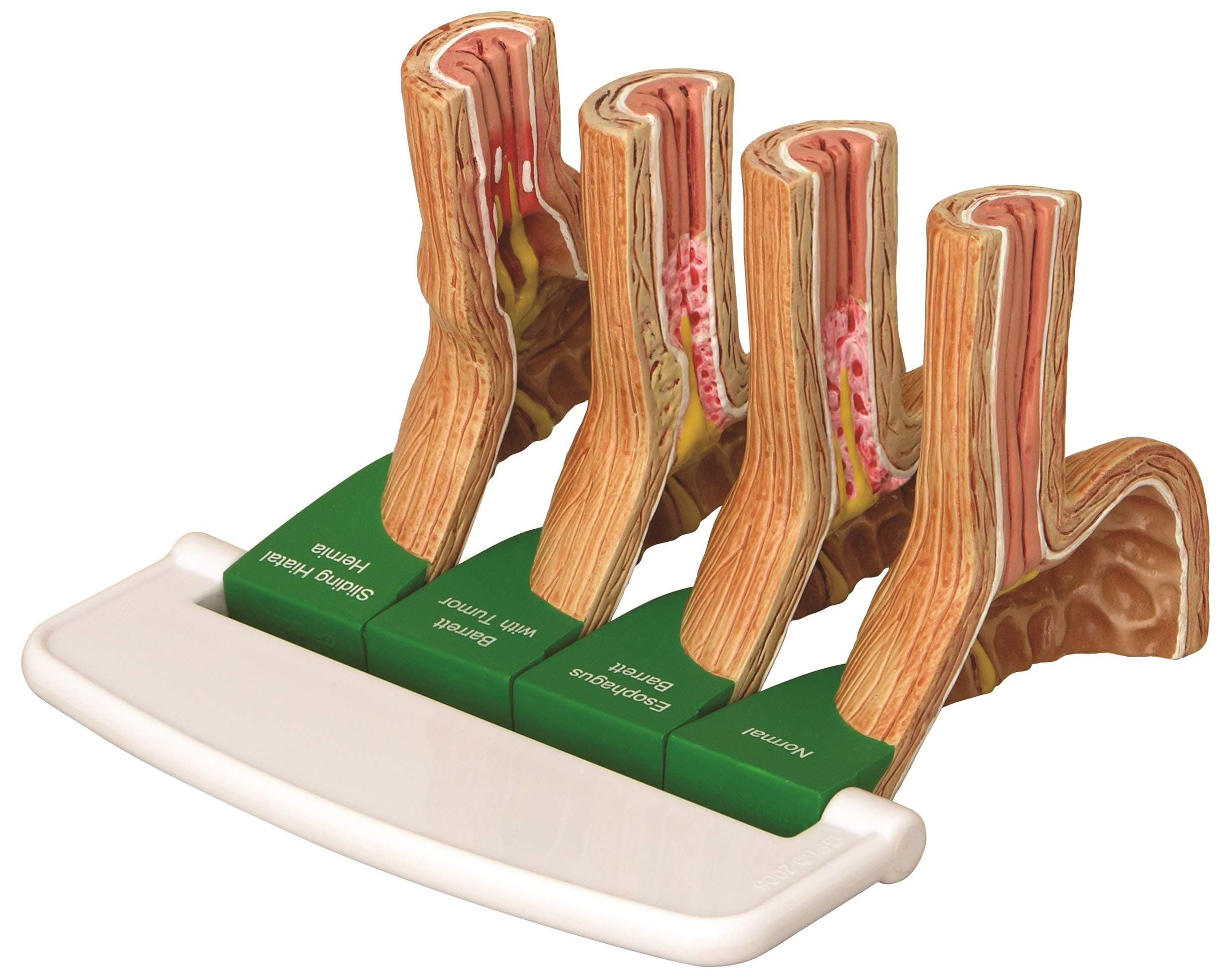 GastroEsophageal Reflux Disease GERD Model #2010
